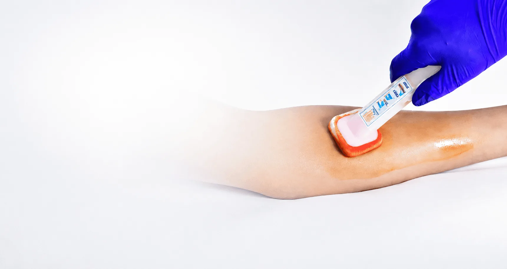 CHG applicators and swab sticks for pre-surgical skin antisepsis